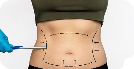 Tummy Tuck