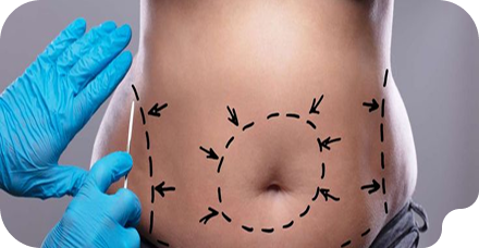 Liposuction